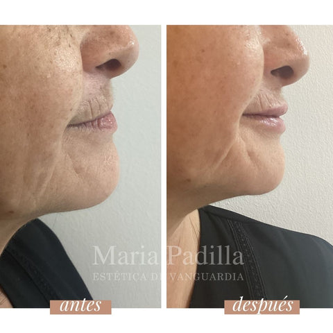 Teosyal Lips Antiage