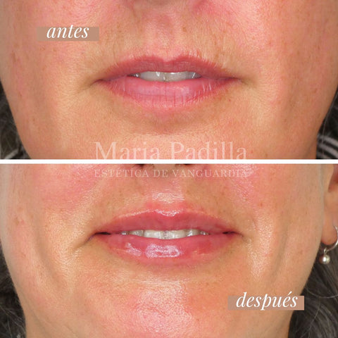 Teosyal Lips Antiage