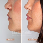 Teosyal Lips Antiage